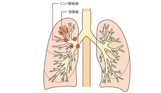 【がん検診】肺がんの正しい知識
