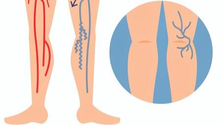 【健康】足の血管の病気「下肢静脈瘤」を正しく知ろう